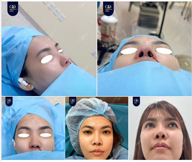Chúc mừng chị HN với dáng mũi mới