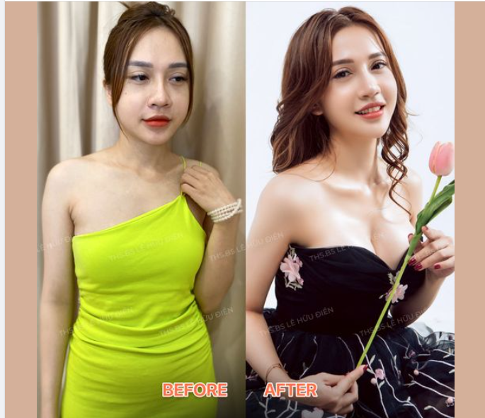 NÂNG CẤP VÒNG 1 TEO LÉP BẰNG CÔNG NGHỆ NÂNG NGỰC HARMONIC TẠI DrD.