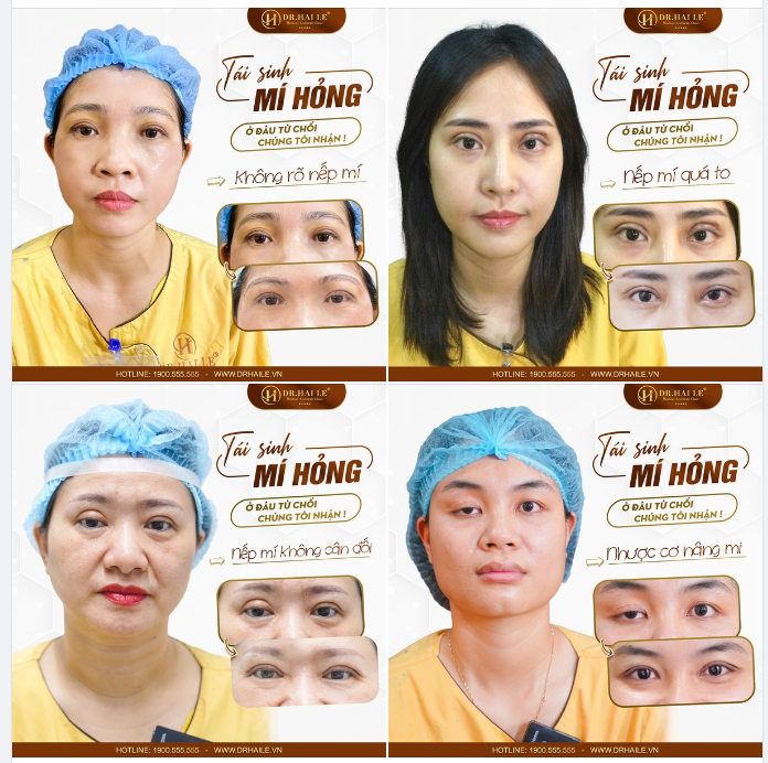 Khắc phục hoàn hảo mọi ca mí hỏng tại dr Hải Lê