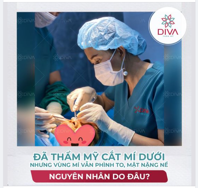 ĐÃ TRẢI QUA THẨM MỸ CẮT MÍ MẮT DƯỚI NHƯNG VÙNG MÍ DƯỚI VẪN PHÌNH TO, MẮT NẶNG NỀ - NGUYÊN NHÂN LÀ GÌ?