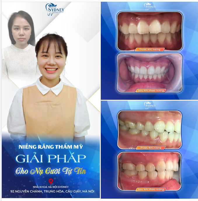NIỀNG RĂNG THẨM MỸ - GIẢI PHÁP CHO NỤ CƯỜI TỰ TIN