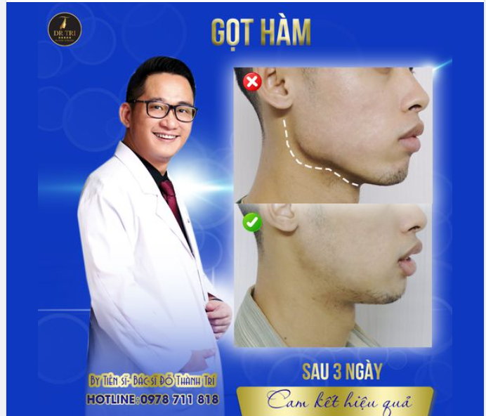 Chỉ cần 3 ngày sẽ có đường viền hàm mượt mà