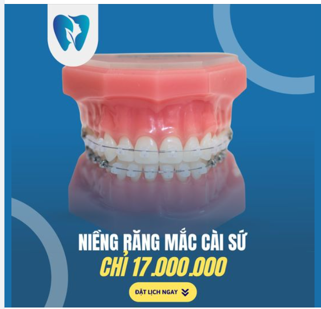 NIỀNG RĂNG MẮC CÀI SỨ - HIỆU QUẢ VÀ THẨM MỸ CAO