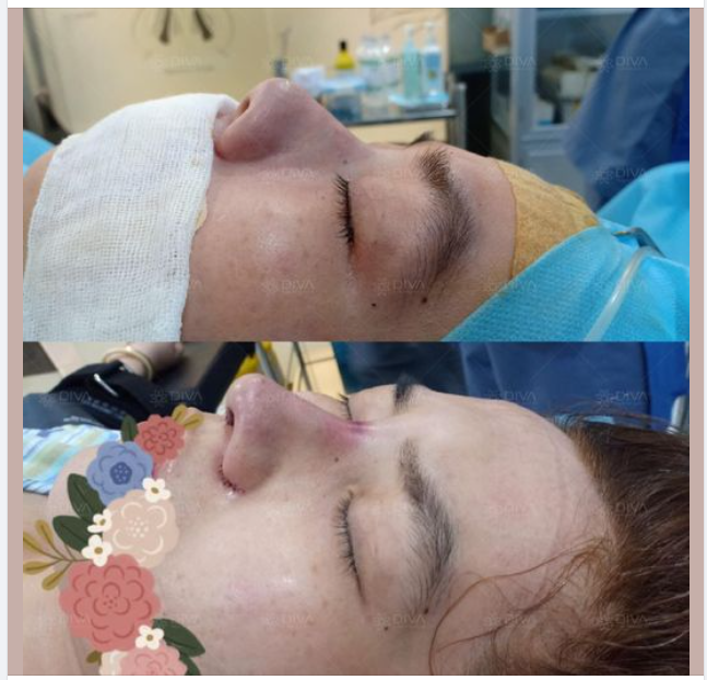 Mũi hếch Mũi thấp Chóp mũi to Tất cả sẽ được khắc phục ngay nhờ phương pháp Nâng mũi Sline tại DIVA
