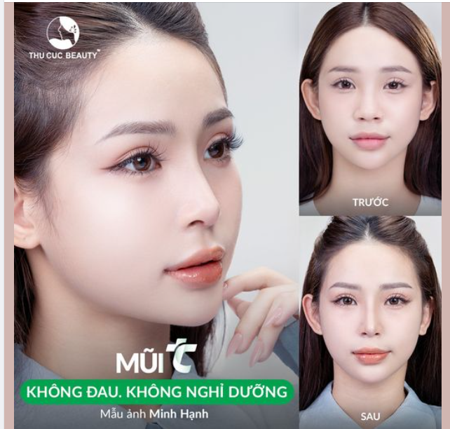 30P Nâng mũi có ngay dáng mũi cao, đẹp ngay sau làm 