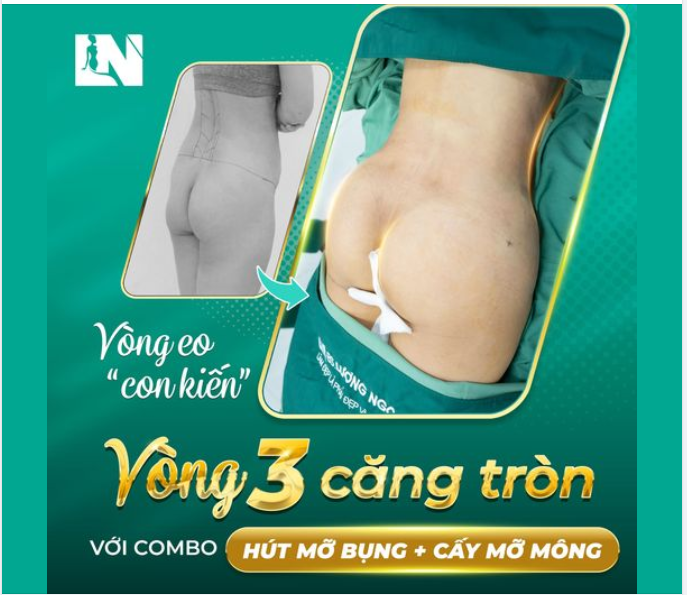 “ĐỘ” V2 THON NUỘT, V3 NẢY NỞ TỰ NHIÊN VỚI COMBO HÚT MỠ BỤNG KẾT HỢP CẤY MỠ MÔNG