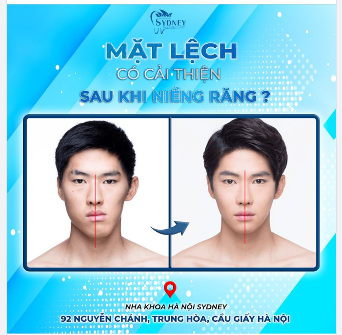 NIỀNG RĂNG CÓ CẢI THIỆN MẶT LỆCH NHƯ LỜI ĐỒN?