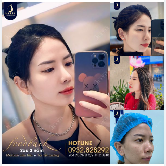 Feedback mũi bán cấu trúc sau 3 năm của em gái