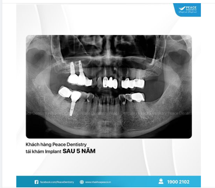 TÁI KHÁM SAU 5 NĂM TRỒNG RĂNG IMPLANT TẠI PEACE DENTISTRY