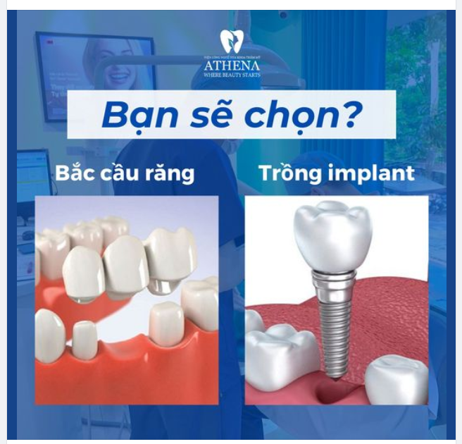So Sánh Cầu Răng Sứ Và Implant Loại Nào Tốt?