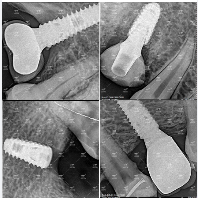 Trụ implant khi trồng vào xương hàm sẽ như thế nào?