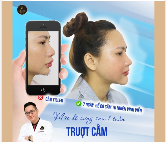 Lo sợ filler không tan, cô gái tới Dr Trí nạo filler và quyết định Trượt cằm vĩnh viễn