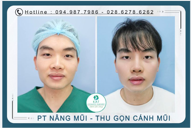 Lỗ mũi to, cánh mũi rộng và bẹt khiến gương mặt bạn thiếu sự cân đối
