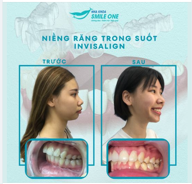 So với phương pháp niềng răng sử dụng mắc cài và dây cung, thì niềng răng trong suốt là phương pháp niềng răng hiện đại, có tính thẩm mỹ cao nhờ việc sử dụng các khay niềng trong suốt để nắn chỉnh thay cho các mắc cài.