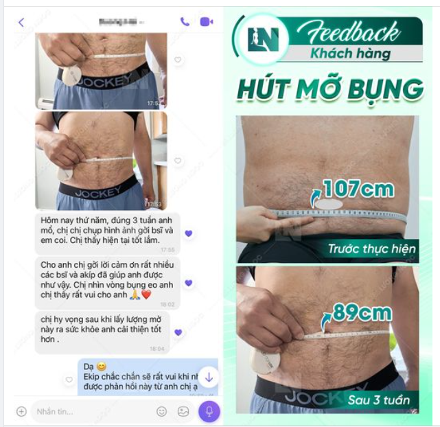 FEEDBACK NÓNG HỔI THÀNH QUẢ HÚT MỠ BỤNG CÙNG EKIP BÁC SĨ LƯƠNG NGỌC