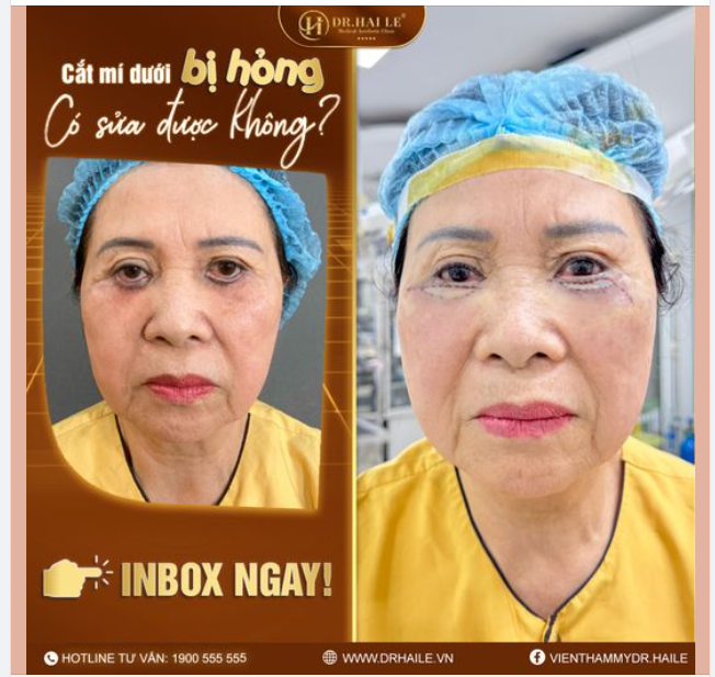 Cắt mí dưới bị hỏng có sửa lại được không?