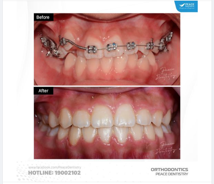 NIỀNG RĂNG TỪ SỚM GIÚP RÚT NGẮN THỜI GIAN ĐIỀU TRỊ!