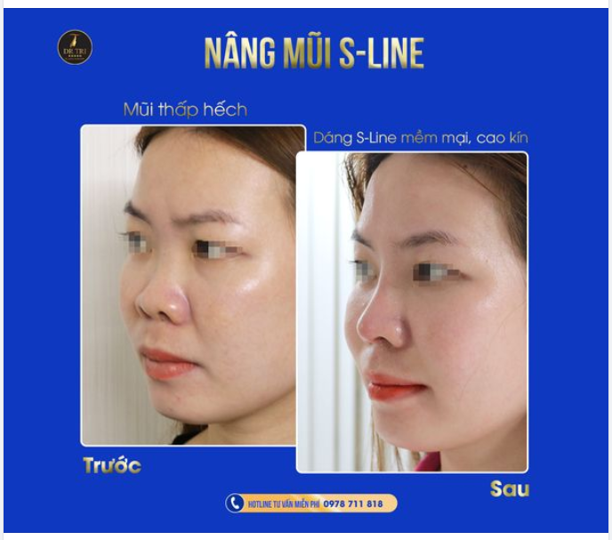 CUỐI TUẦN MỜI CẢ NHÀ XEM CẬN CẢNH 1 CA NÂNG MŨI S-LINE