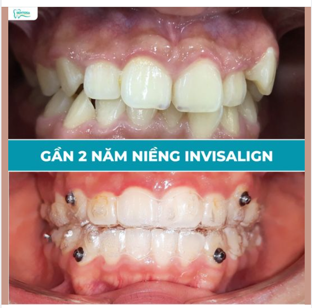 Gần 2 năm mang niềng và đổi lại được gì?