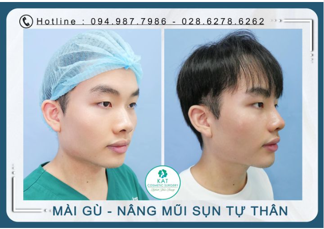 Phẫu thuật thẩm mỹ dành cho người đàn ông