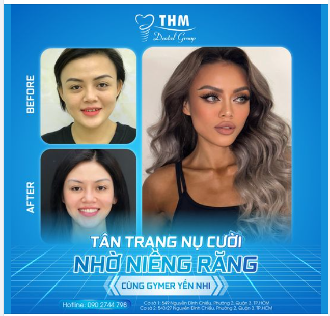 TÂN TRANG NỤ CƯỜI NHỜ NIỀNG RĂNG CÙNG GYMER YẾN NHI