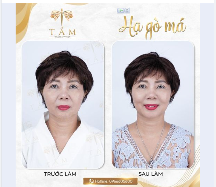 Nhiều khách ib hỏi Tấm về dịch vụ Tiêm hạ gò má - kỹ thuật tiêm tưởng dễ mà lại khó.