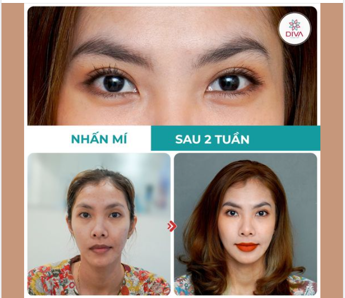 NHẤN MÍ MẮT VĨNH VIỄN TẠI DIVA: MẮT 2 MÍ CÂN ĐỐI, TỰ NHIÊN