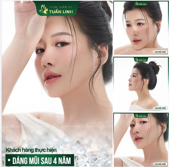 Nâng mũi bọc sụn - Dáng mũi sau 4 năm đẹp tự nhiên!