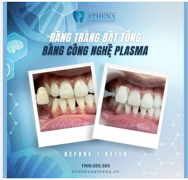 Công nghệ tẩy trắng răng bằng đèn Plasma ở ATHENA có gì đặc biệt?