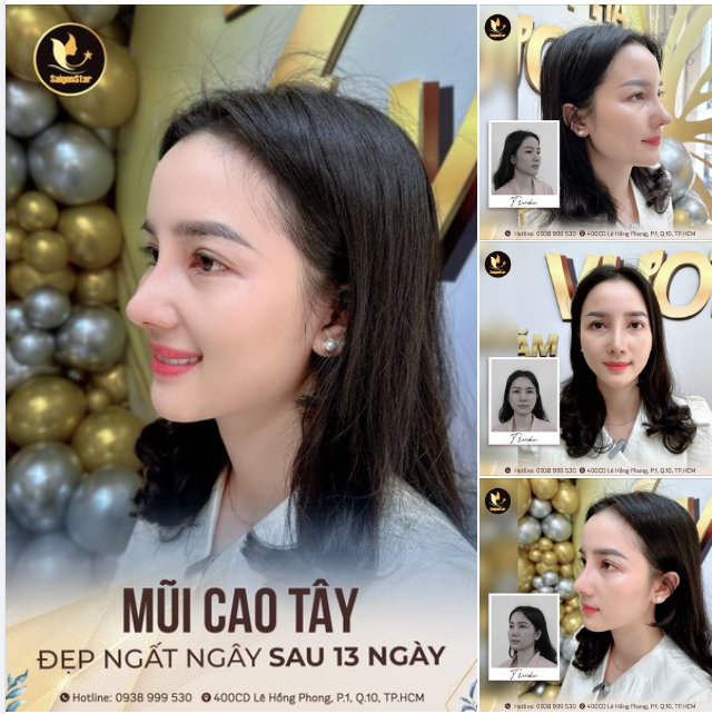 MŨI CAO TÂY – ĐẸP NGẤT NGAY SAU 13 NGÀY