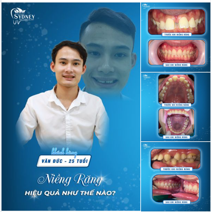 NIỀNG RĂNG HIỆU QUẢ NHƯ THẾ NÀO?