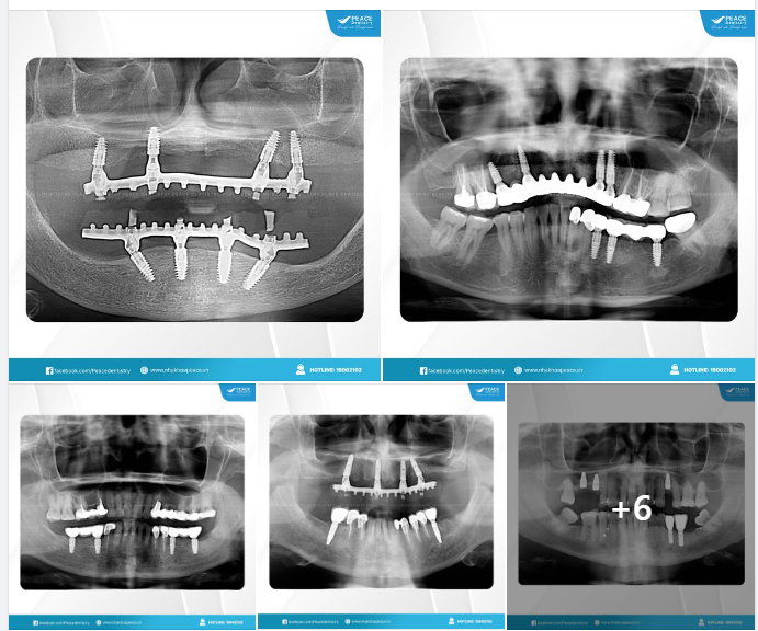 CẦN CẤY BAO NHIÊU TRỤ IMPLANT TRONG CÁC TRƯỜNG HỢP MẤT RĂNG KHÁC NHAU?