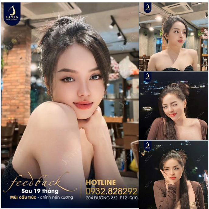 Nâng mũi và cái kết hơn cả MONG ĐỢI
