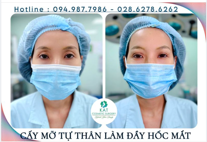 Cấy mỡ tự thân hốc mắt là phương pháp sử dụng mỡ thừa ở một số vùng, bộ phận trên cơ thể (như đùi, bắp tay, bụng,..) của chính bạn để cấy ghép vào vùng mắt trũng sâu.