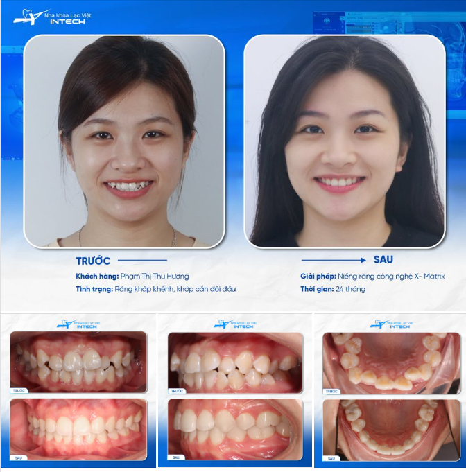 NIỀNG RĂNG ĐỂ HIỆN THỰC HÓA ƯỚC MƠ ĐƯỢC BAY CAO