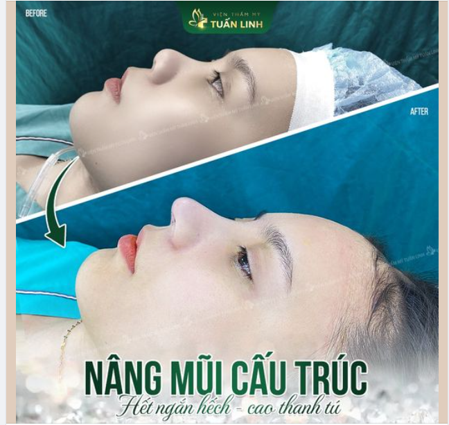 Mũi hết ngắn hếch, thấp tẹt. Đẹp ngay sau 90 phút thực hiện