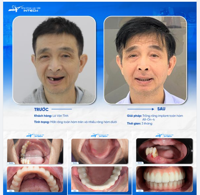 TẠM BIỆT KHUÔN MẶT MÓM MÉM, GIÀ TRƯỚC TUỔI SAU 3 THÁNG ĐIỀU TRỊ TẠI LẠC VIỆT INTECH