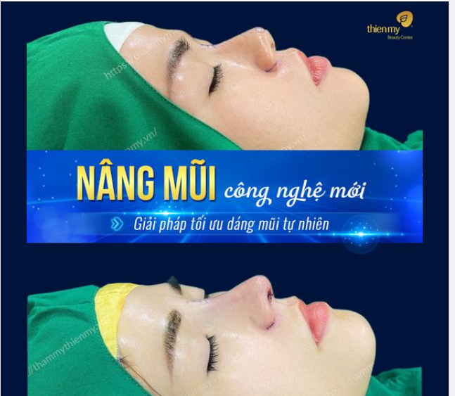 HÌNH ẢNH THỰC TẾ KHÁCH HÀNG SAU NÂNG MŨI