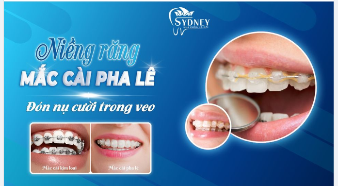 NIỀNG RĂNG MẮC CÀI PHA LÊ - ĐÓN NỤ CƯỜI TRONG VEO