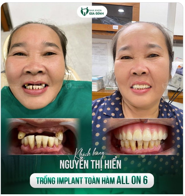 HỒI SINH NỤ CƯỜI SAU KHI TRỒNG RĂNG IMPLANT BẰNG CÔNG NGHỆ MỚI NHẤT HIỆN NAY