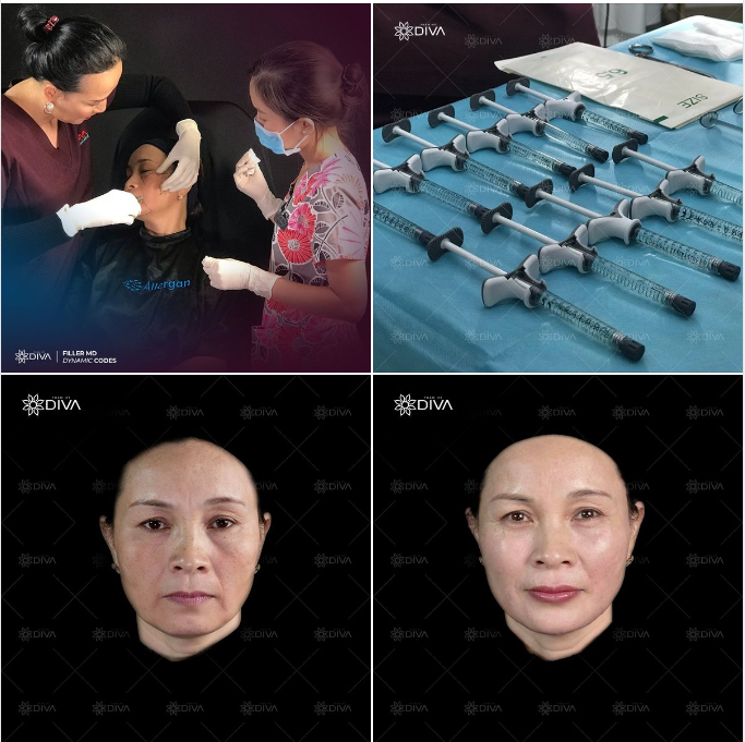 TIÊM FILLER NHIỀU, MẶT CÓ BỊ PHÌNH TO RA?