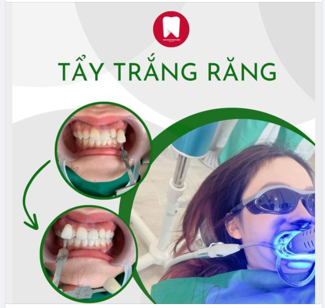 TẨY RĂNG TRẮNG - ĐÓN NỤ CƯỜI TOẢ NẮNG