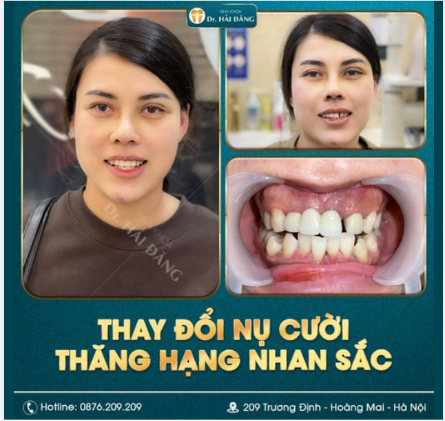 KHẮC PHỤC NỤ CƯỜI ĐẸP CHO KHÁCH HÀNG BỌC SỨ BỊ HỎNG