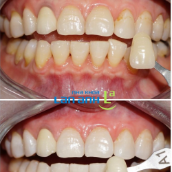 Bạn lưu ý thuốc tẩy trắng răng không có tác dụng với răng sứ nhé!
