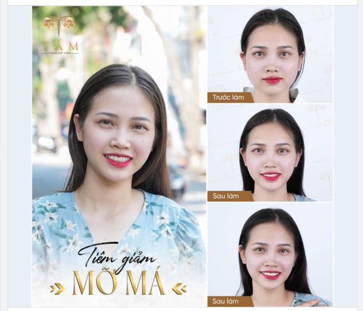 Ăn kiêng, tập luyện không bằng hơn 30 phút tiêm giảm mỡ má