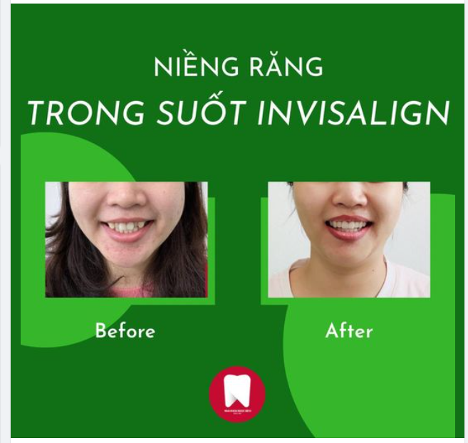 "SAU KHI THÁO NIỀNG, RĂNG MÌNH THAY ĐỔI 180 ĐỘ LUÔN"