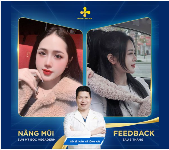 Feedback nâng mũi sụn Mỹ bọc Megaderm sau 6 tháng của bạn Thu Quỳnh