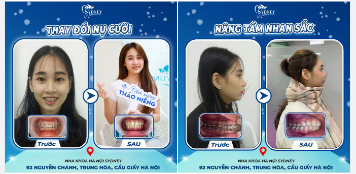 THAY ĐỔI NỤ CƯỜI - NÂNG TẦM NHAN SẮC