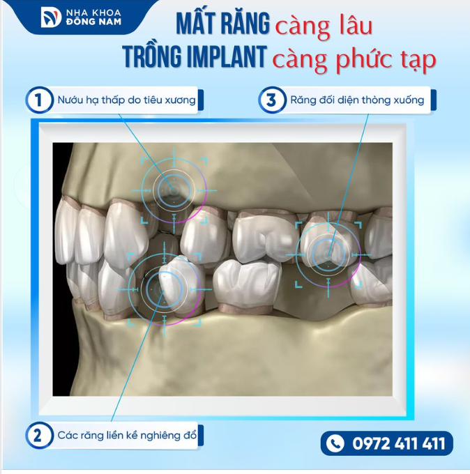  MẤT RĂNG CÀNG LÂU, TRỒNG RĂNG IMPLANT CÀNG PHỨC TẠP LẠI ẢNH HƯỞNG ĐẾN HIỆU QUẢ