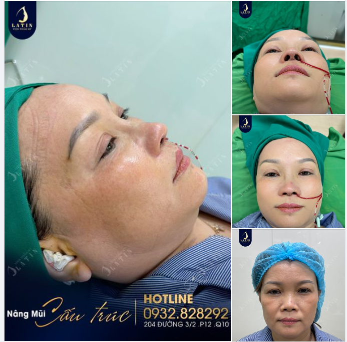 Khách hàng trung niên đến từ Bạc Liêu nâng mũi cấu trúc, lót megaderm